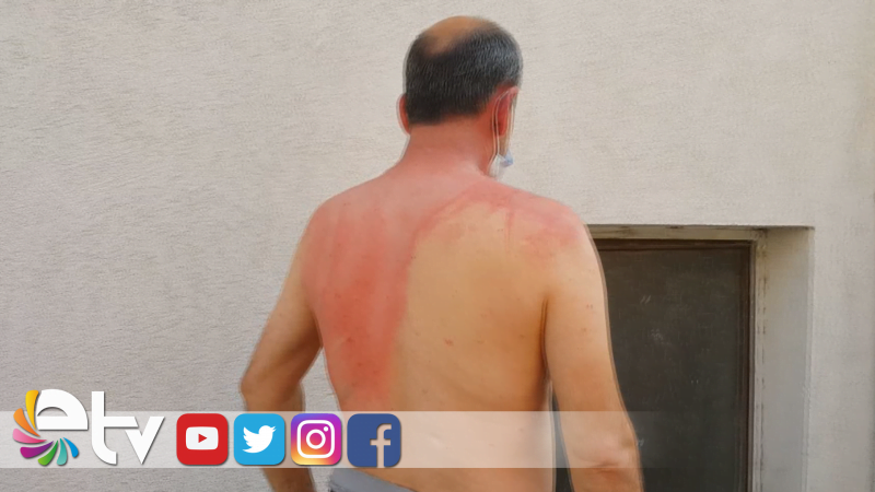 KOMŞUSUNU KAYNAR SUYLA YAKTI