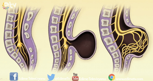 ‘SPİNA BFİDA’YI ANLATTI