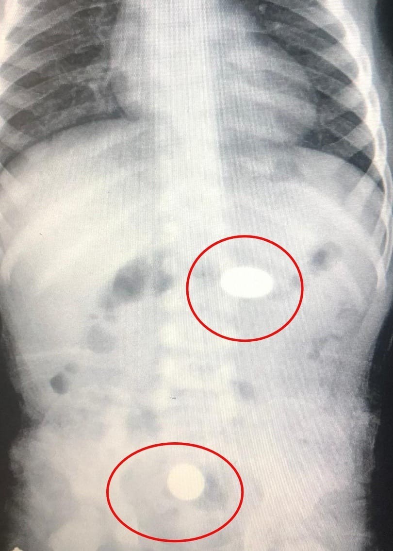 Bursa’nın İnegöl ilçesinde meydana gelen olayda yerde bulduğu 2 adet 50 kuruşu şeker zannedip yutan bebek, hastanede tedavi altına alındı. Olay ...