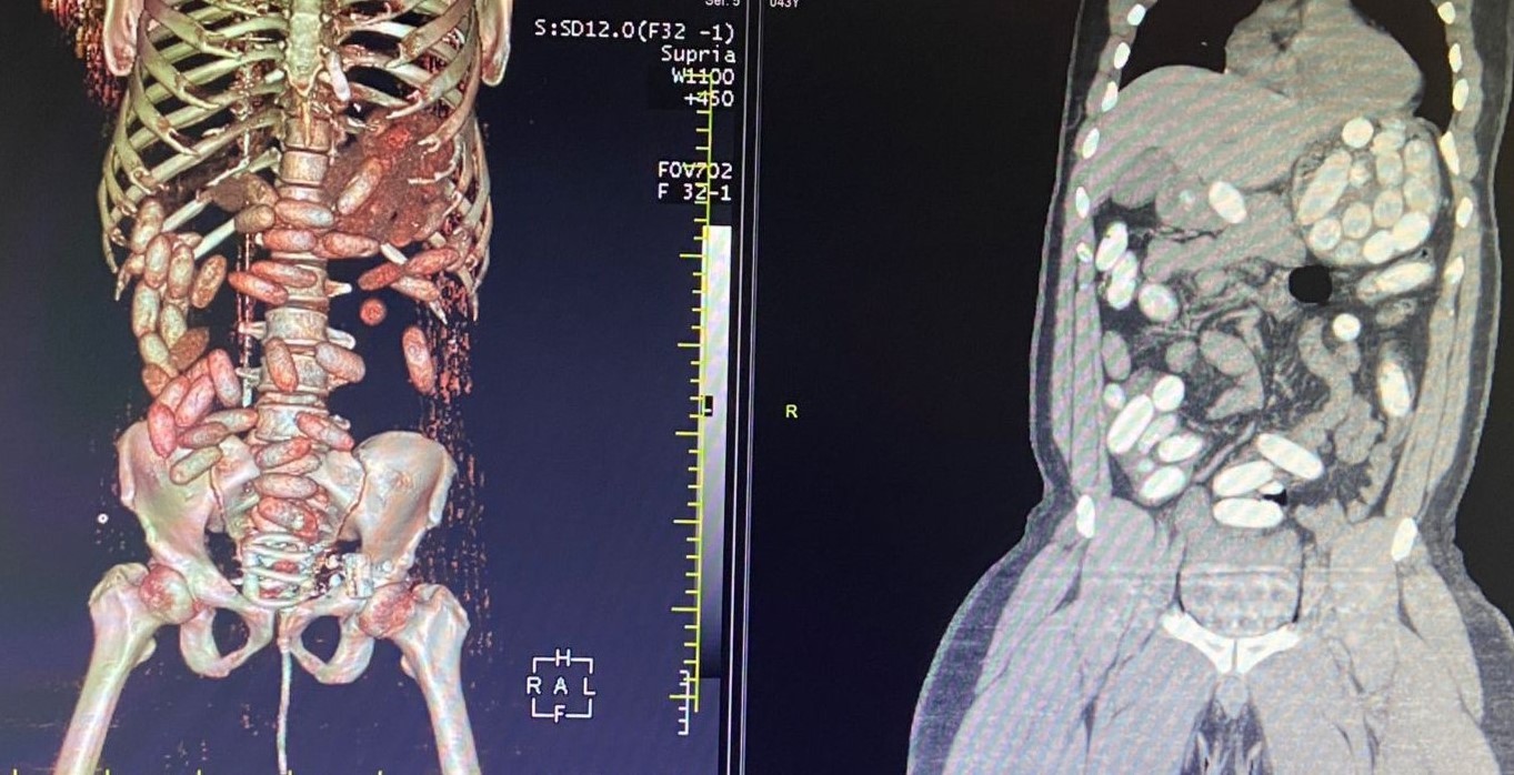 İstanbul Havalimanı’nda gerçekleştirilen iki ayrı uyuşturucu operasyonunda 11 kilo kokain ele geçirildi. Biri organizatör, yedisi kurye olmak ...