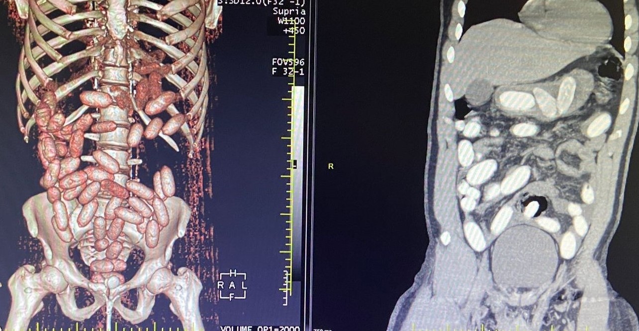 İstanbul Havalimanı’nda gerçekleştirilen iki ayrı uyuşturucu operasyonunda 11 kilo kokain ele geçirildi. Biri organizatör, yedisi kurye olmak ...