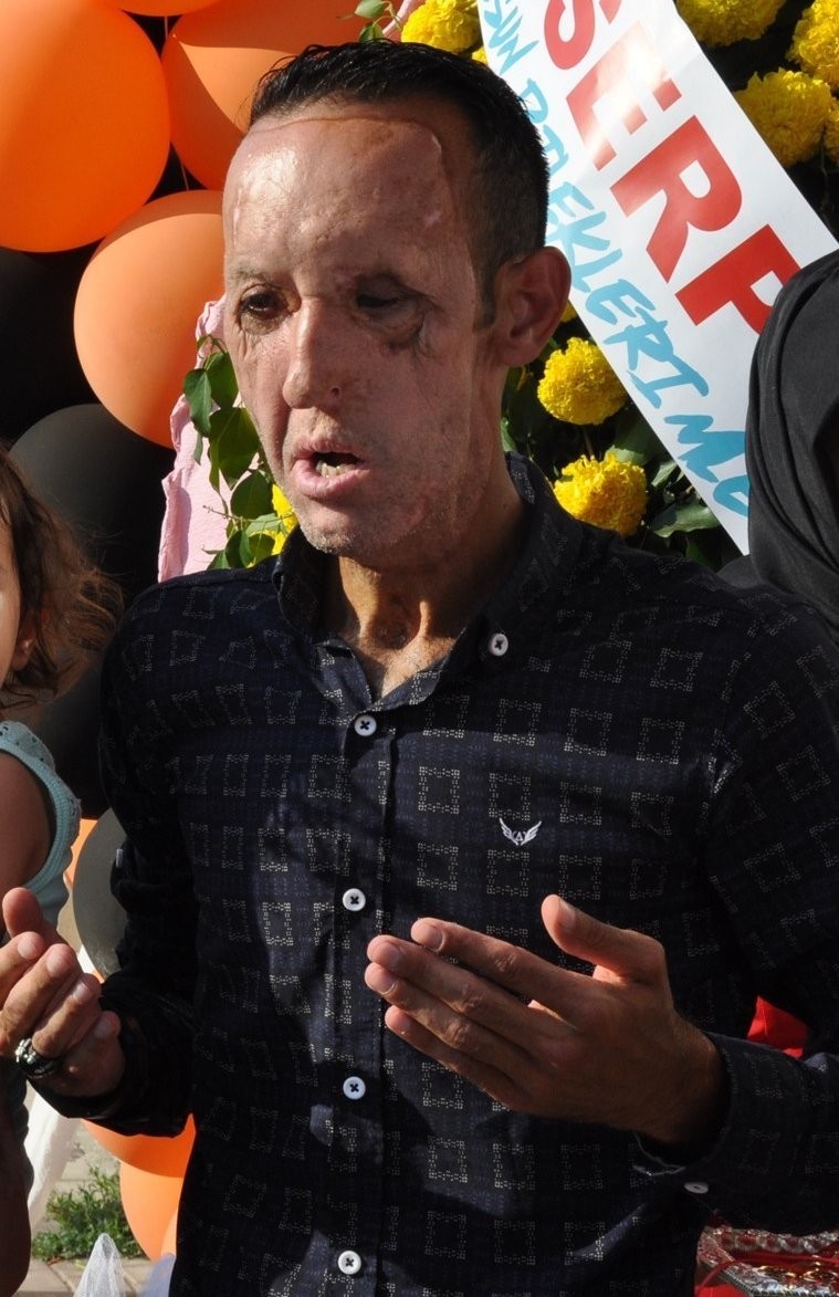 Yüz nakli yapılan Recep Sert gözaltına alındı Balıkesir’in Edremit ilçesinde narkotik polisinin yaptığı operasyonda gözaltına alınan 10 kişi arasında yüz ve çene nakli yapılan Recep Sert’in ...