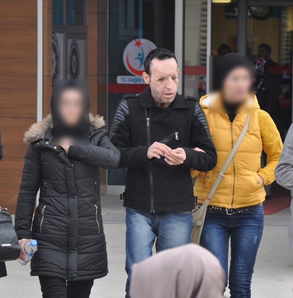 Yüz nakli yapılan Recep Sert gözaltına alındı Balıkesir’in Edremit ilçesinde narkotik polisinin yaptığı operasyonda gözaltına alınan 10 kişi arasında yüz ve çene nakli yapılan Recep Sert’in ...